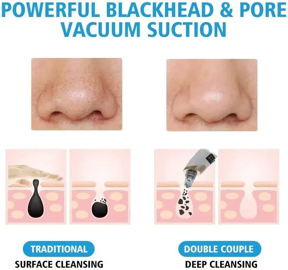 Multifunction Blackhead Remover – 5-in-1 Deep Pore Cleansing