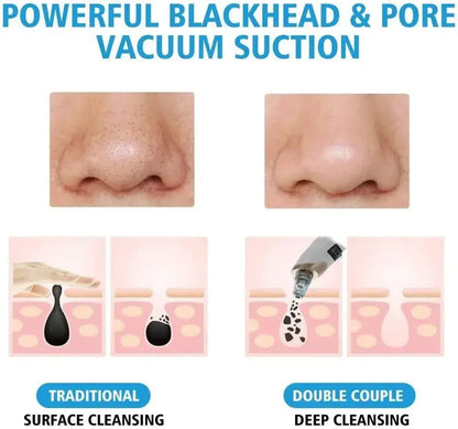 Multifunction Blackhead Remover – 5-in-1 Deep Pore Cleansing